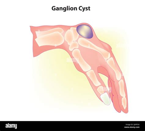 Ganglion cyst on the hand Stock Photo - Alamy
