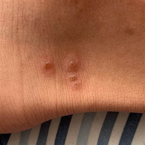 Image result for Jigger Bug Parasite