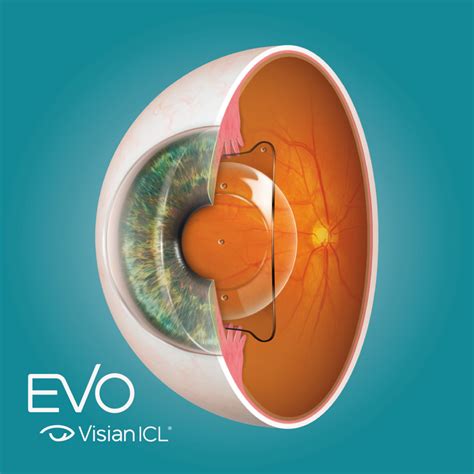 EVO Visian ICL - Conheça O Novo Implante Intraocular - Oftalmologia
