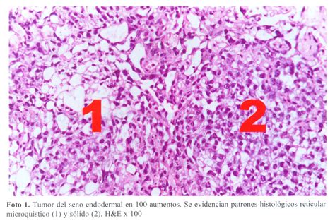 Tumor Do Saco Vitelino Corpos De Schiller Duval Shuller Duval Bodies