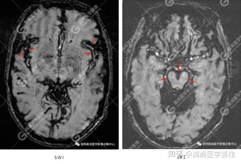 脑组织铁沉积神经变性病临床与影像诊断（二）_signal