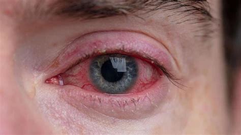 Conjunctivitis Symptoms And Treatment : ঘরে ঘরে চোখ লাল- ব্যথা-জল কাটছে ...
