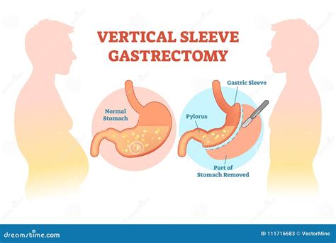 Vertical Sleeve Gastrectomy Medical Vector Illustration Diagram with Stomach Surgical Cut. Stock ...