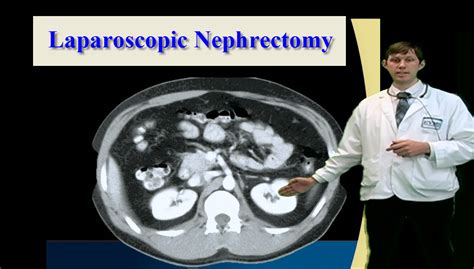 Image result for Simple Nephrectomy
