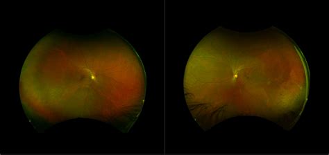 California - Mild Non-Proliferative Diabetic Retinopathy with Macular ...