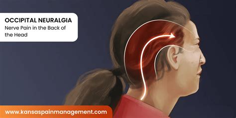 Occipital Neuralgia in Kansas City | Kansas Pain Management