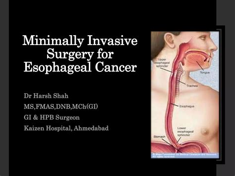 Mis carcinoma Esophagus | PPTX