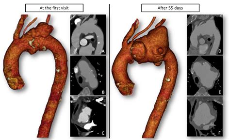 SciELO Brasil - Contained rupture of an aortic arch aneurysm in a ...