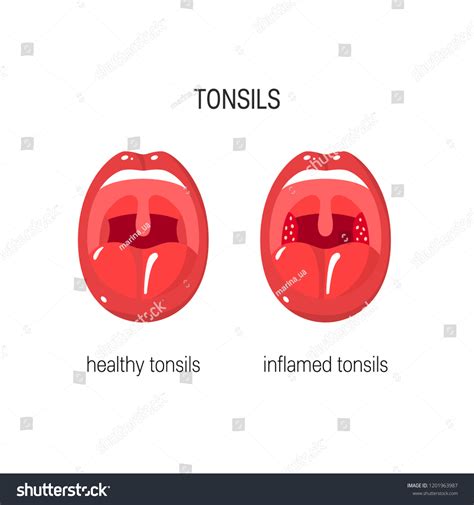 Normal Tonsil