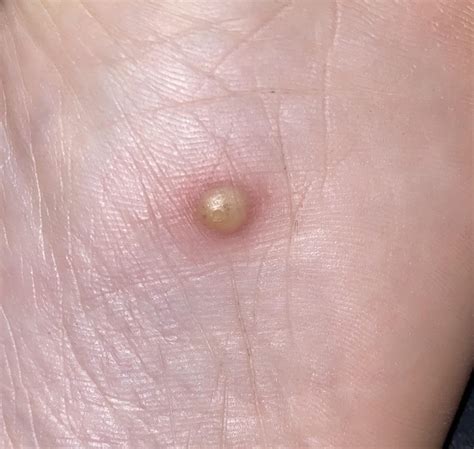 Is this a plantar wart? I’ve never had one before. Not sure what to do? I see black dots inside ...