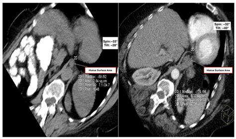 Association Between Thoracic Kyphosis and Hiatal Enlargement: A CT ...