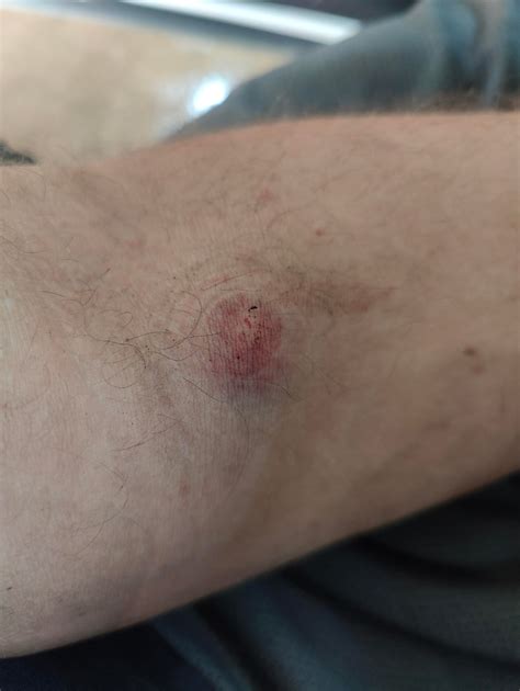 Panicking before donating? Blood pressure spike and pouring sweat. : r/Blooddonors