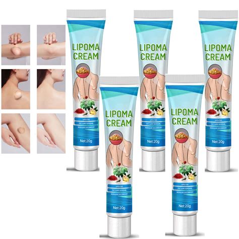 Buy LumpFree Lipoma Removal Cream, al Lipoma Lumps Removal Cream ...