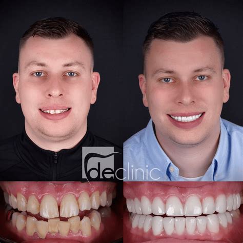 Zirconia Crowns