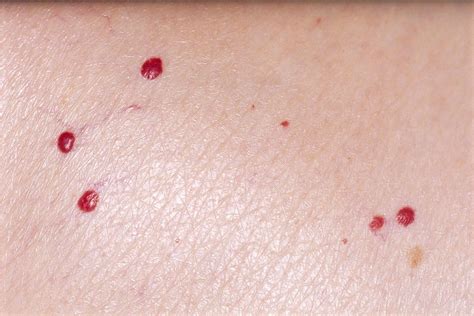 Cysts, Lumps and Bumps: Causes, Symptoms, Treatments