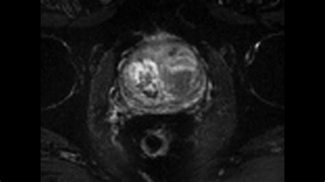 Body MRI - Siemens Healthineers India