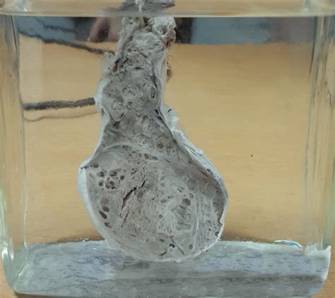 Testicular Cancer Teratoma Symptoms at Alicia Tuckett blog