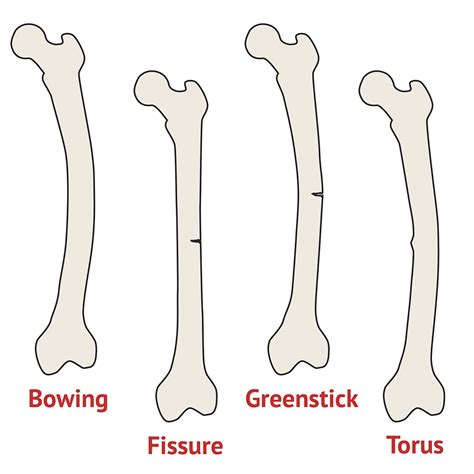 Break Versus Fracture