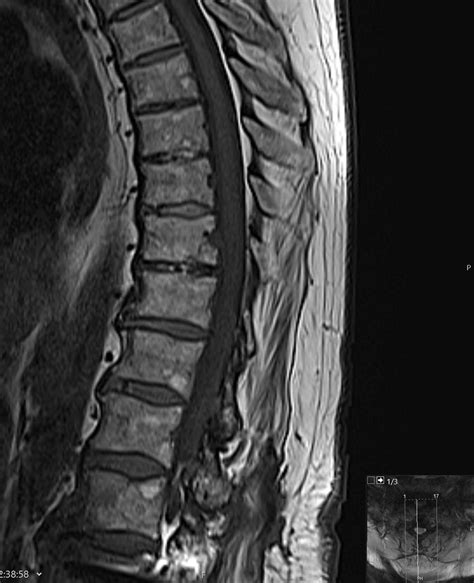 Disc space narrowing and osteophytes - Clinical Tree