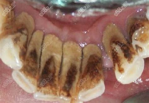 如何判断自己得了牙周炎?你看过牙周病的图片吗?,专家提醒-8682赴韩整形网