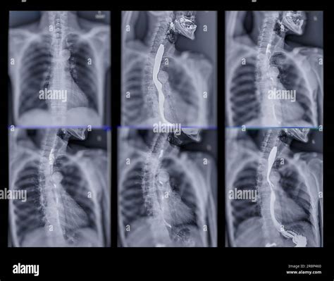 Barium Swallow study test diagnose Barrett's GI tract exam GERD ulcers ...