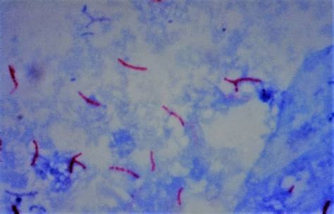 Image result for Acid-Fast Bacilli Staining Method