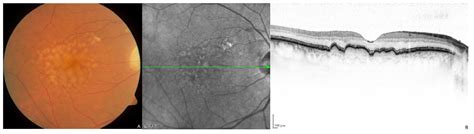Molecular Genetic Mechanisms in Age-Related Macular Degeneration