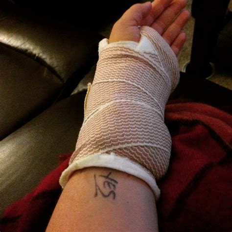 Ganglion Cyst Removal