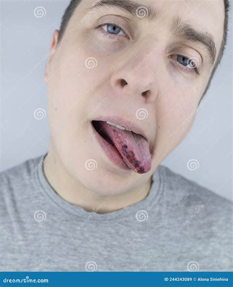 Black Tongue. a Man Shows the Consequences of an Injury, Bite or Burn of the Tongue. Part is ...