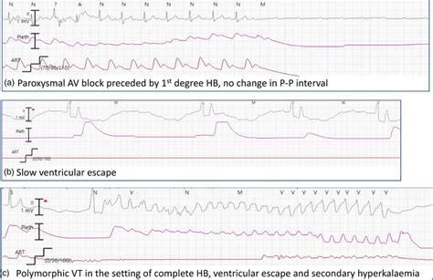 Image result for Synchronized Cardioversion Rhythm Strip