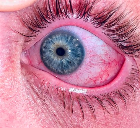 Image result for Welding Flash Dispersion