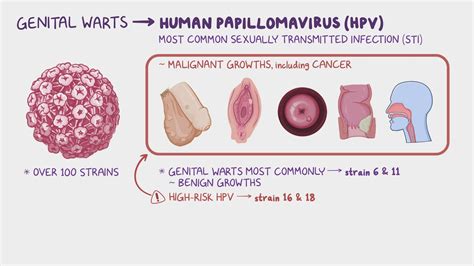 Hpv Strains That Cause Cancer