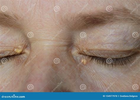 Close Up of Woman Eyes with Xanthelasma on the Eyelids. Hypercholesterolemia, High Cholesterol ...
