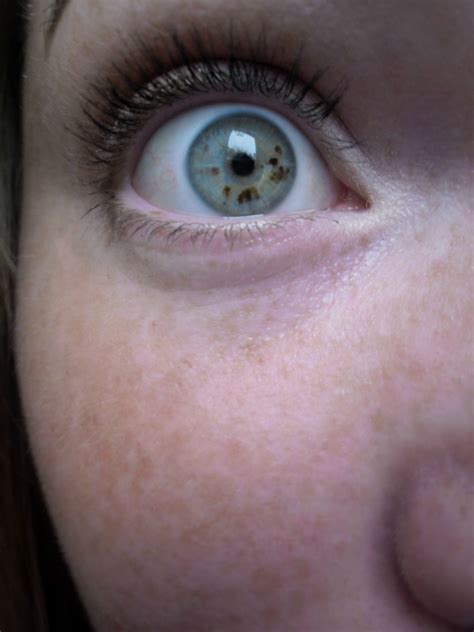 Freckled face, freckled eyes, freckles everywhere! : eyes
