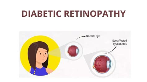 Planning to Get Diabetic Retinopathy Treatment? Here is Everything You ...
