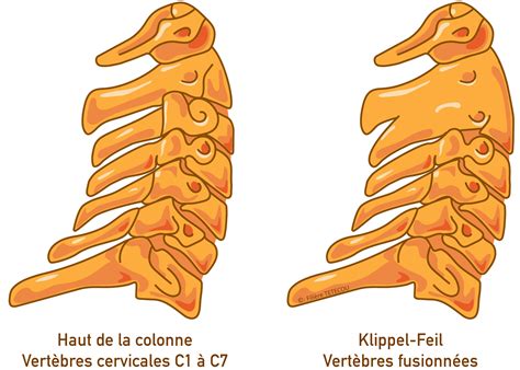 Syndrome de Klippel-Feil