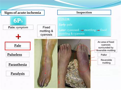 ACUTE LIMB ISCHEMIA SURGICAL management.pptx