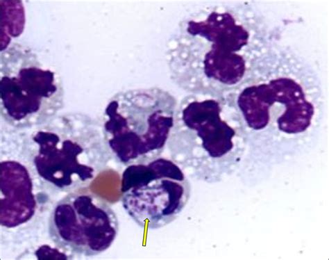 Anesthesia Airway Lavage 的图像结果