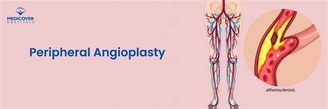 Peripheral Angioplasty in Secunderabad: Treatment for Blocked Leg Arteries