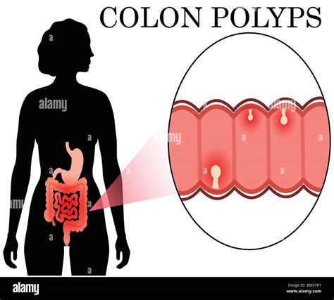 Colon Polyps Medical Illustration – Digestive System Disease and Gastrointestinal Health Vector ...