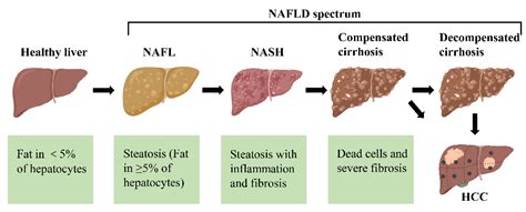 Non-Alcoholic Fatty Liver Disease (NAFLD) Pathogenesis and Natural Products for Prevention and ...