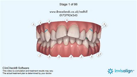 Invisalign Animation 的图像结果