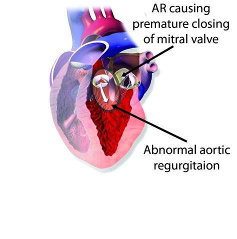 Aortic Regurgitation Murmur