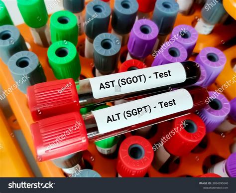 2,800 Blood Test For Liver Disease Images, Stock Photos & Vectors | Shutterstock