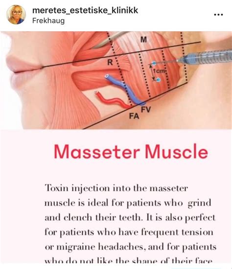 Image result for Botox Injection Patterns