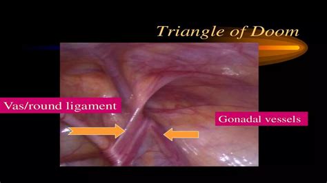 Laparoscopic anatomy of inguinal hernia | PPTX