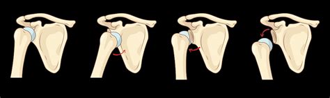 How to Tell If Your Shoulder Is Dislocated - Dr. Eric Giang