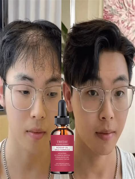 Hair Growth Treatment Nourishing Serum For Dry Fragile Curly Hair ...