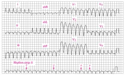 Image result for AFib Detection Algorithm