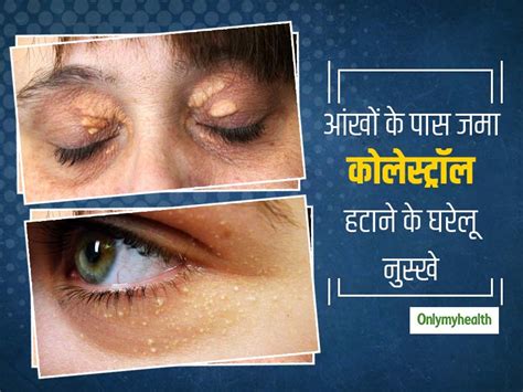 5 Home Remedies to Remove Cholesterol Deposits Around Eyes (Xanthelasma ...